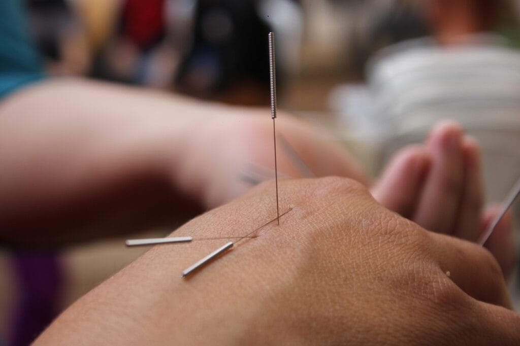 acupuncture, needles, hand, medicine, physiotherapy, therapy, traditional, wellness, skin, spa, closeup, acupuncture, acupuncture, acupuncture, acupuncture, acupuncture